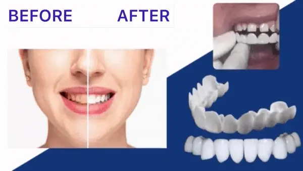 Snap On Smile - Μασελάκι Μεταμόρφωσης Χαμόγελου - Αφαιρούμενη Οδοντική Όψη Ρητίνης για Άνω ή Κάτω Γνάθο Snap On Smile - Μασελάκι Μεταμόρφωσης Χαμόγελου - Αφαιρούμενη Οδοντική Όψη Ρητίνης για Άνω ή Κάτω Γνάθο