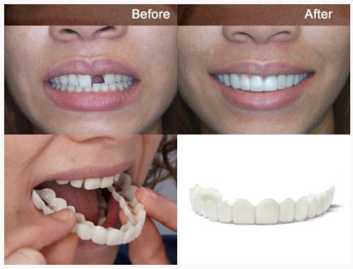 Snap On Smile - Μασελάκι Μεταμόρφωσης Χαμόγελου - Αφαιρούμενη Οδοντική Όψη Ρητίνης για Άνω ή Κάτω Γνάθο