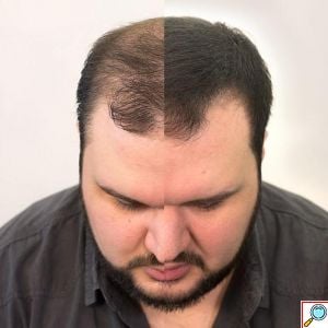 VolumON Hair Building Fibers, Μικρο-ίνες Φυσικής Κερατίνης κατά της Τριχόπτωσης & Αραίωσης των Μαλλιών 12γρ