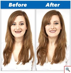 Μασελάκι Perfect Smile για όμορφα δόντια και υπέροχο χαμόγελο, τεχνητή οδοντοστοιχία, εμφυτεύματα δοντιών, ορθοδοντική, σιδεράκια, μασελάκια, στραβά δόντια, θήκες, ναρθηκες δοντιών, ψεύτικα δόντια