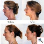 Συσκευή Σύσφιξης και Τόνωσης Λαιμού Neckline Slimmer