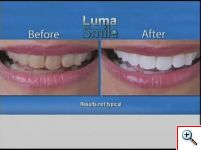 Συσκευή Λεύκανσης Δοντιών Luma Smile 